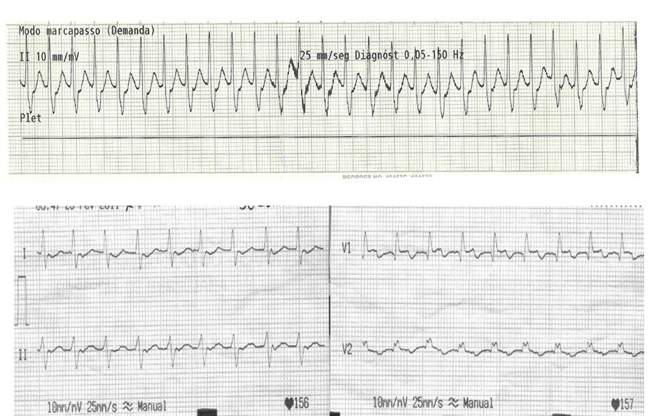 Masculino de 70 años con TPSV post trasplante cardíaco debido a vía accesoria del injerto