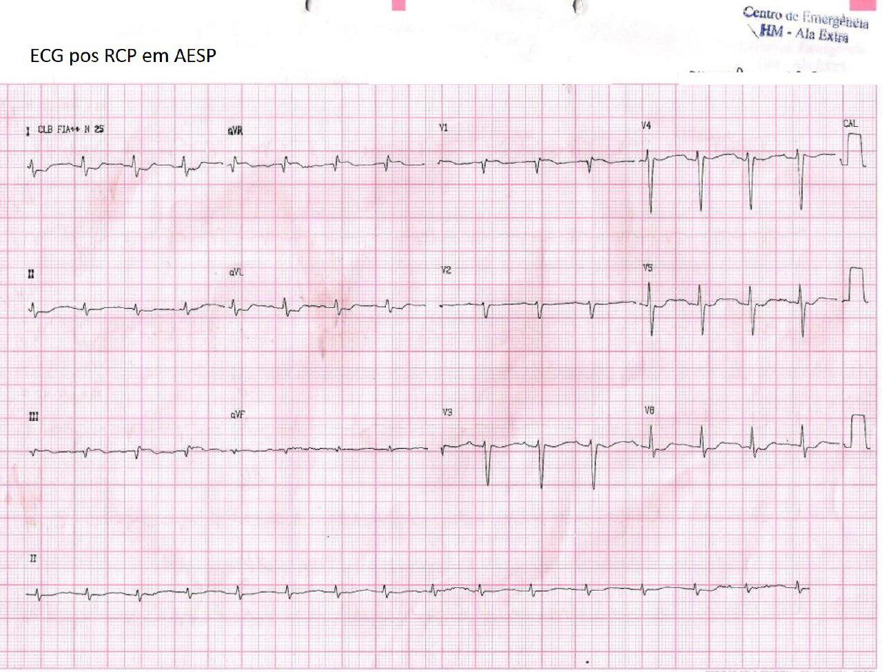 Paciente de 72 años con disnea y sudoración que presenta actividad eléctrica sin pulso por TEP que simula infarto de VD