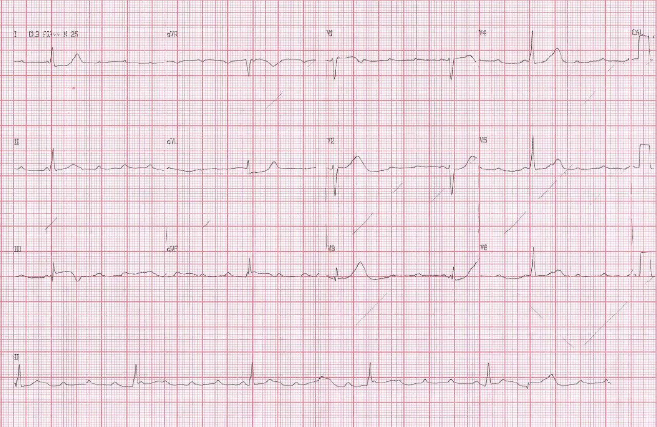 Mujer de 39 años con angor por trombo en CD que se angioplastia y compromiso del NAV