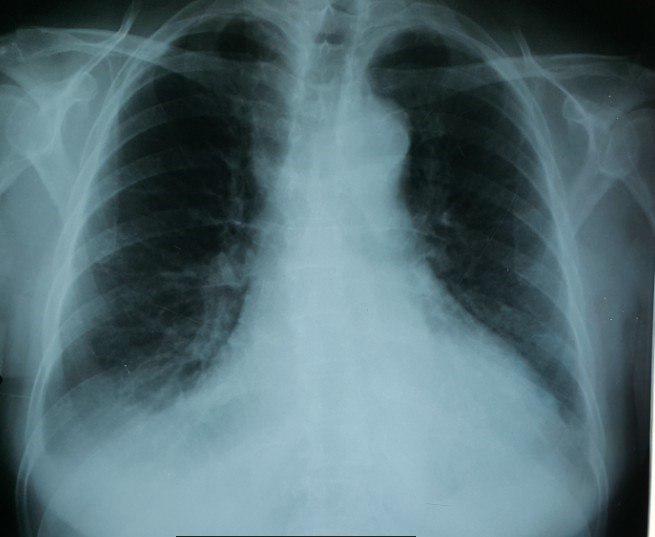 Mujer de 66 años con insuficiencia valvular aórtica de etiología luética