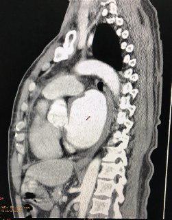 Reemplazo valvular mitral en masculino de 56 años con megaaurícula izquierda y leak periprotésico