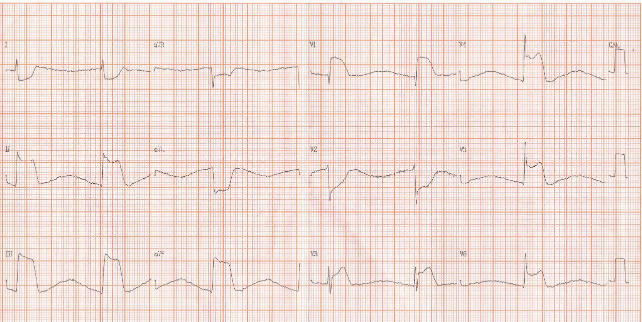 Paciente de 52 años con Infarto inferior con extensión al VD complicado con BAVC