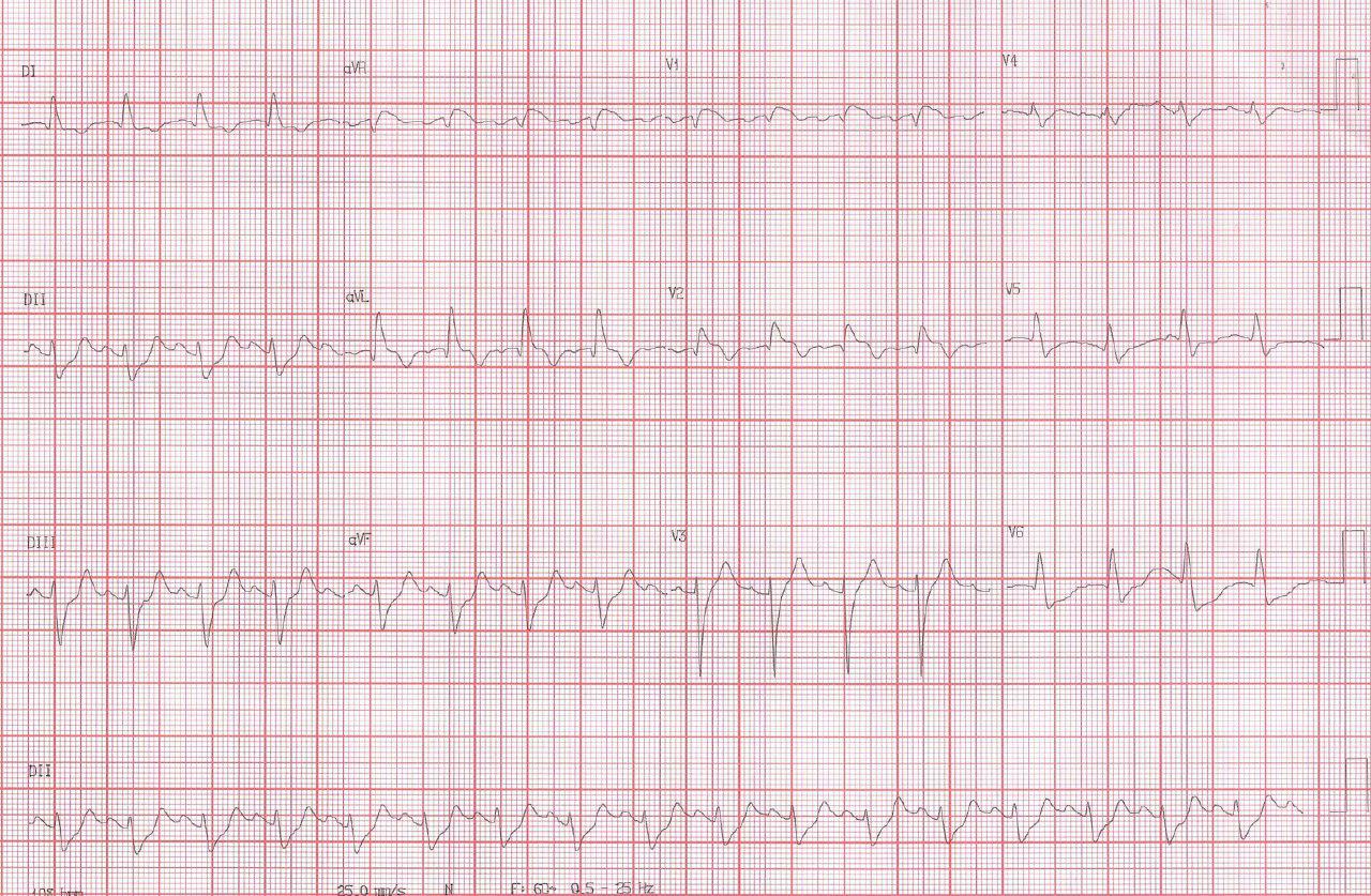 Angor prolongado y edema agudo de pulmón en obstrucción total de TCI