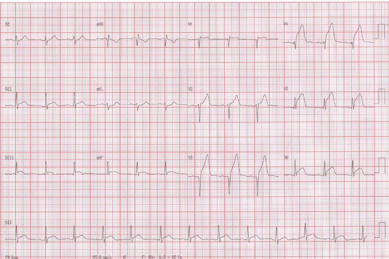 Paciente de 38 años, HIV positivo en tratamiento antiretroviral, con angor prolongado
