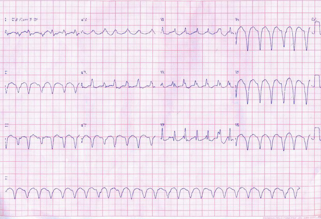 Paciente chagásica con aneurisma VI que desarrolla episodios de TV que no responden a sobrestimulación