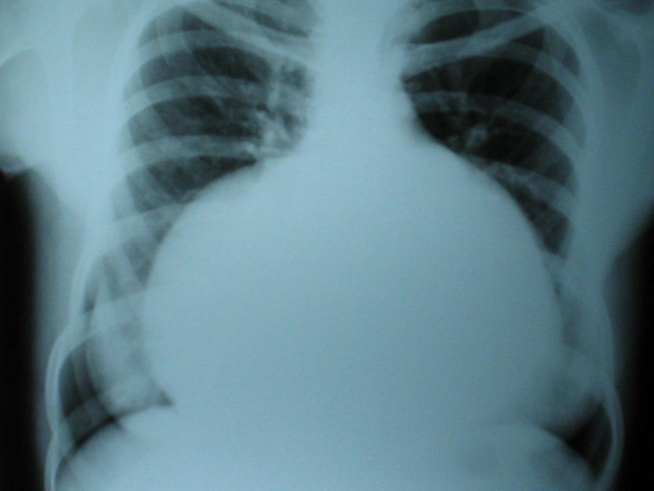 Paciente con reemplazo valvular mitral con severa insuficiencia protésica e insuficiencia tricuspídea