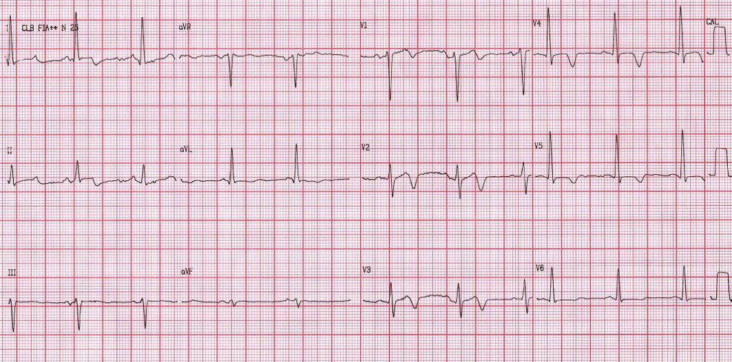 Paciente HTA y DBT con síndrome vertiginoso simulando un SCA, con aumento de troponina. ACV cerebeloso
