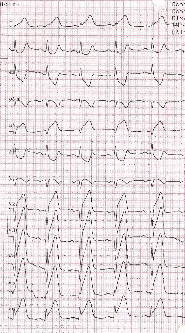 Paciente de 61 años con SCA por lesión de DA. Angioplastia con reperfusión incompleta y RIVA
