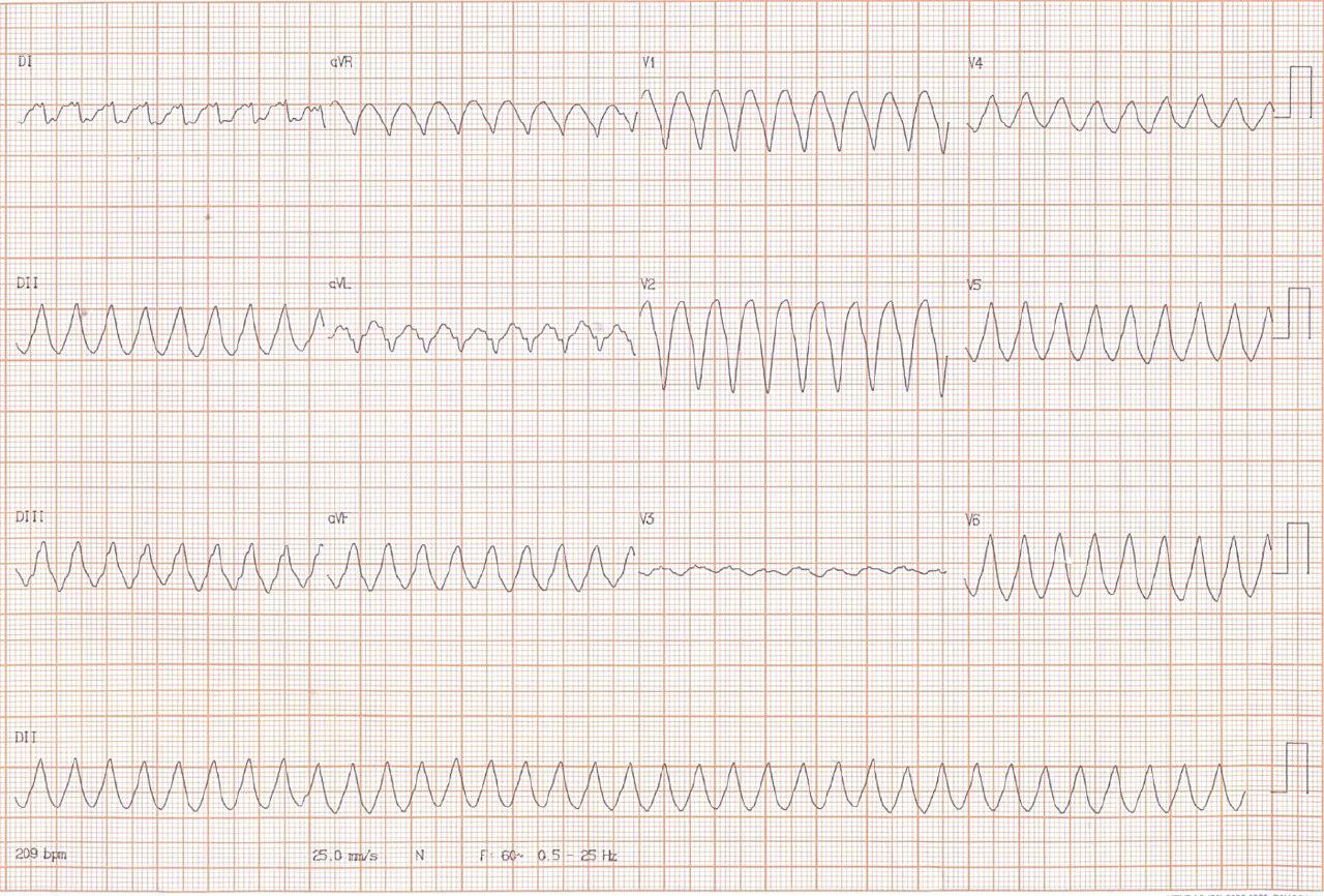 Mujer de 42 años con TV que revierte mediante CVE. Displasia arritmogénica de VD