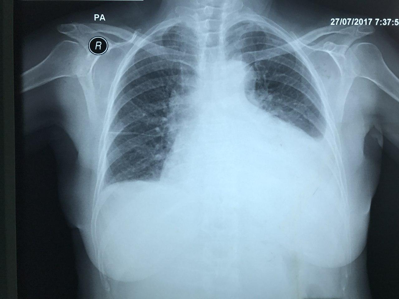 Mujer de 66 años con disnea progresiva y detección mediante TAC de nódulo pancreático