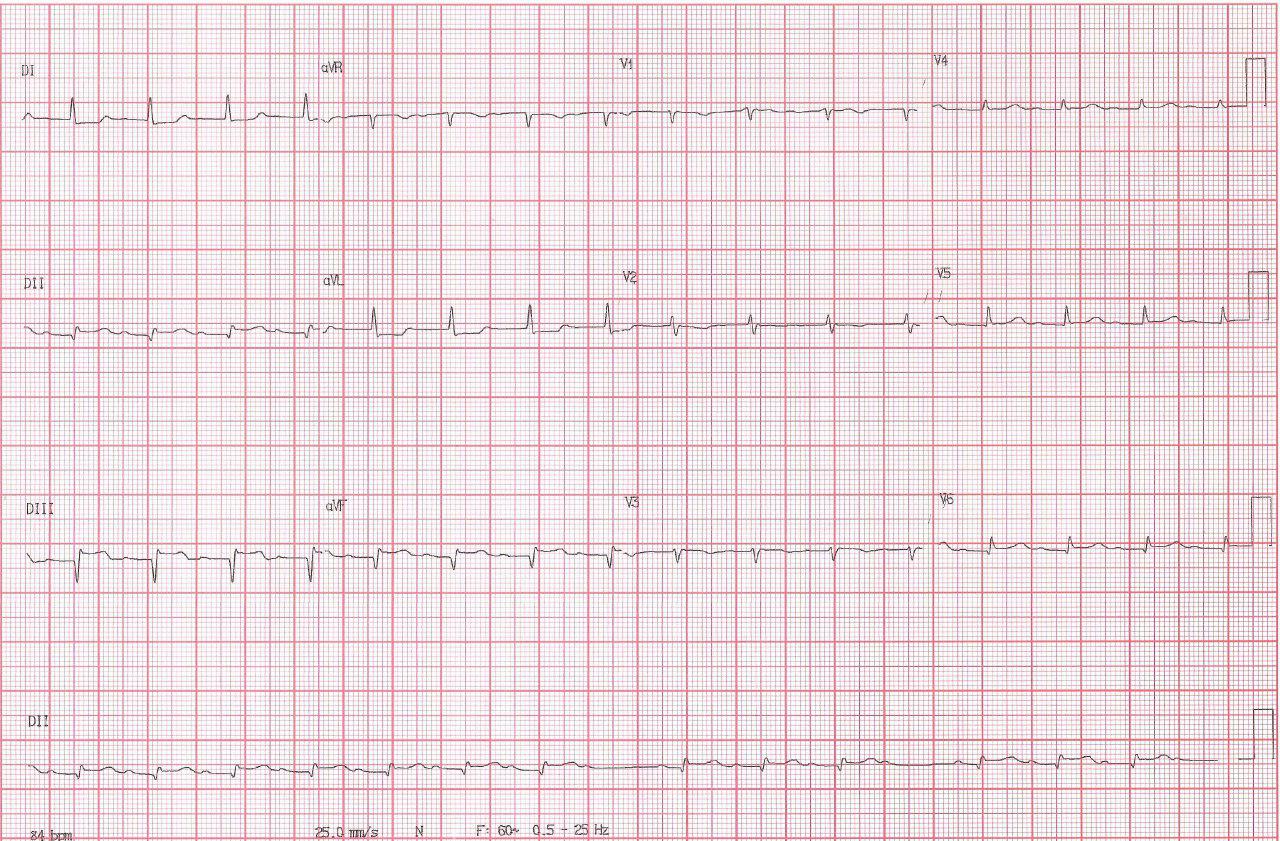 SCACEST con compromiso de VD e inestabilidad hemodinámica