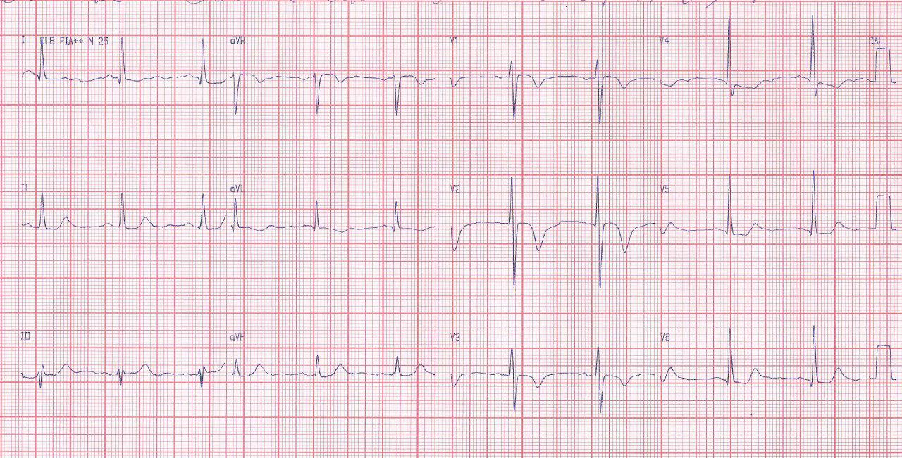 Mujer de 65 años con IAMCEST con BCRI y criterios de Sgarbossa