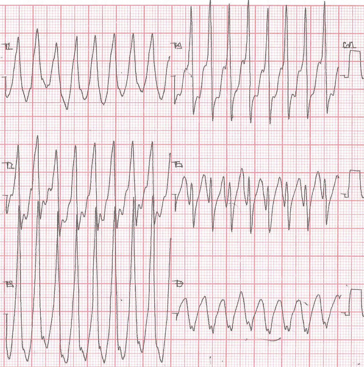 Paciente chagásico con MP implantado presenta TV mediada por MP de origen epicárdico