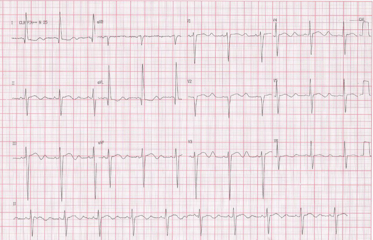 Ondas U prominentes por hipopotasemia en mujer tratada con tiazidas y diarrea