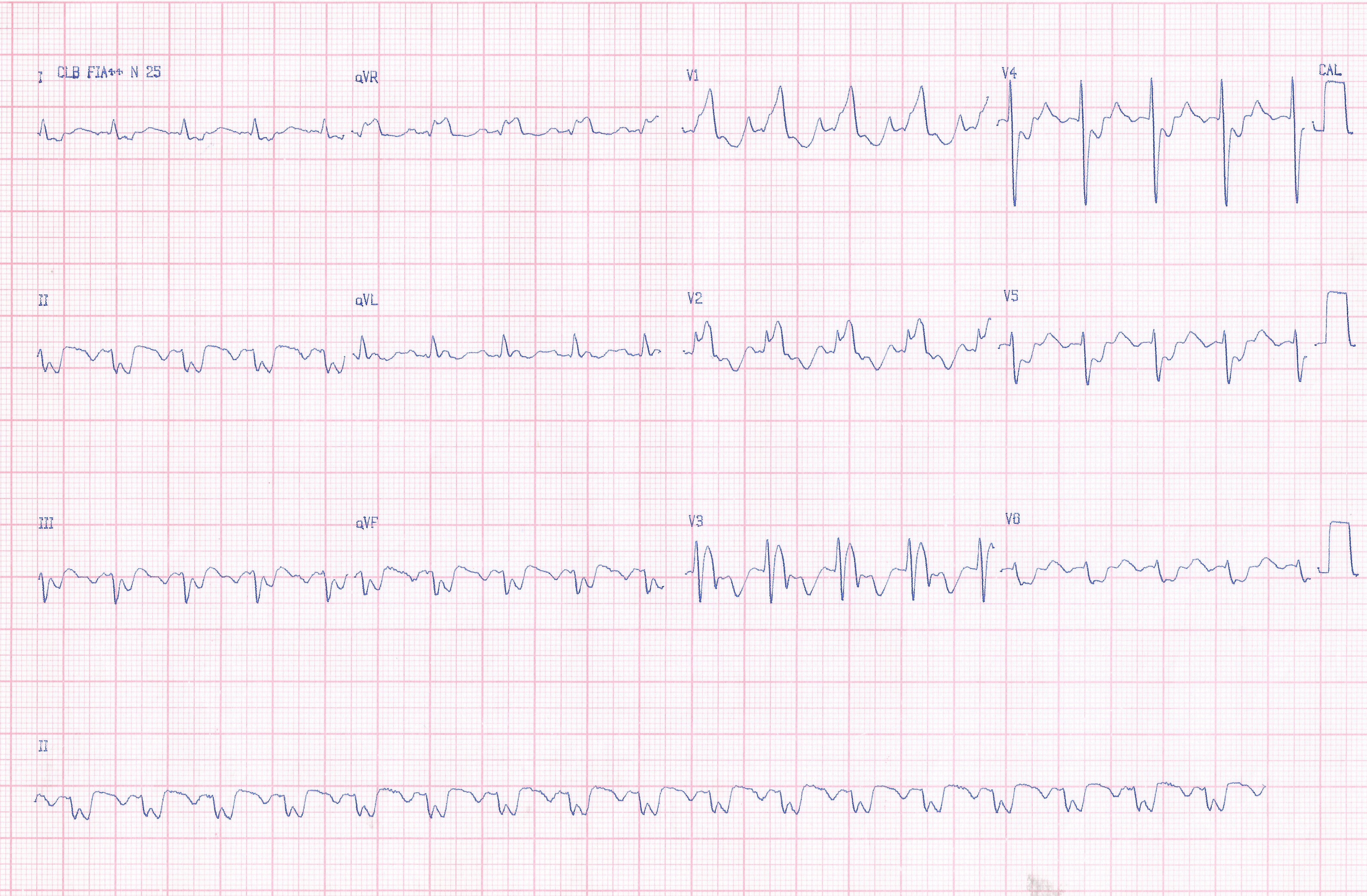 Masculino de 32 años con miocardiopatía hipertrófica no obstructiva con angor y palpitaciones