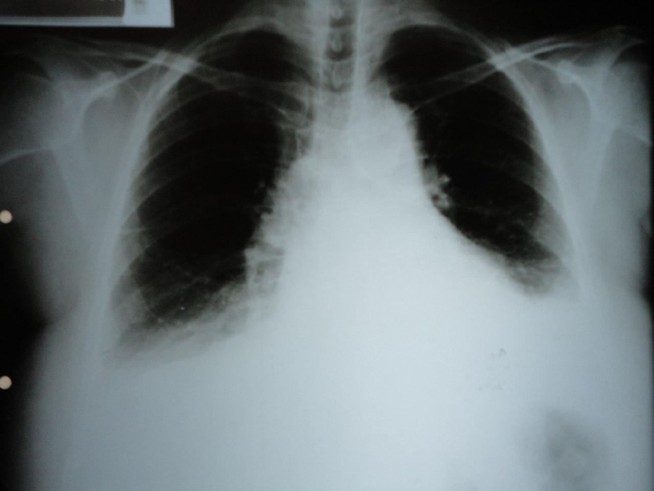 Síndrome de Dressler luego de SCA que mejora con corticoides