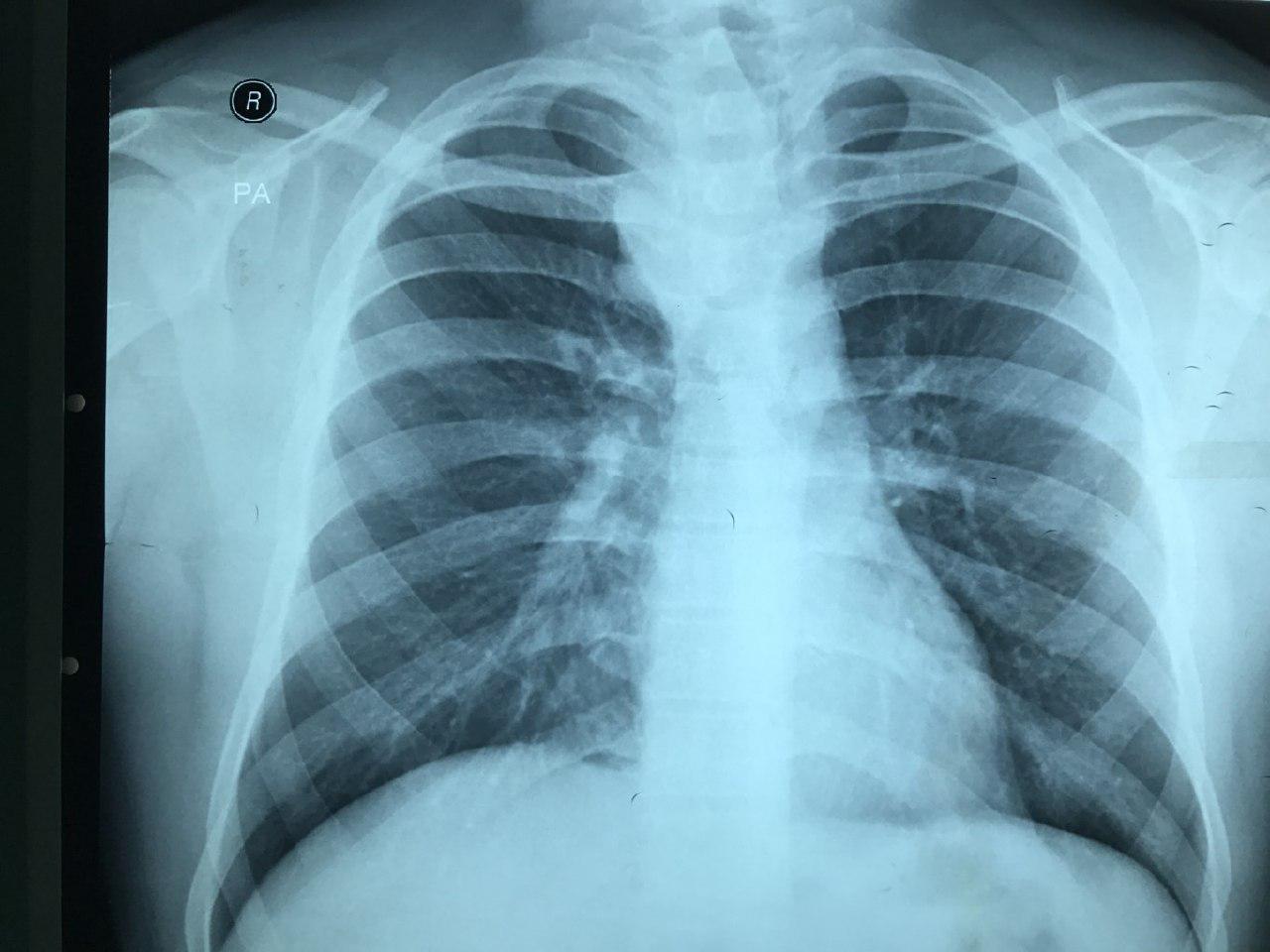Paciente de 28 a con atc de traumatismo de tórax que presenta tos, disnea y ronquera por compresión traqueal por aneurisma del Tr braquicefálico