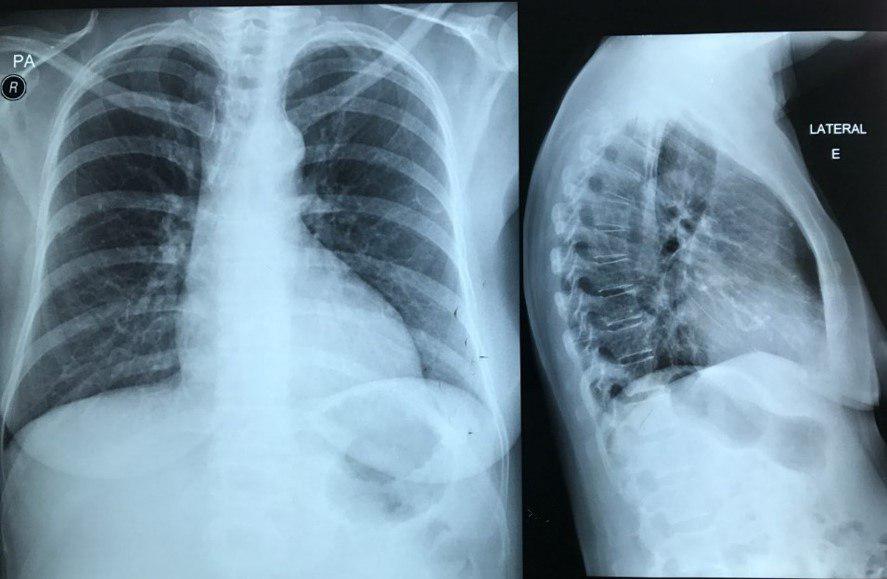 Mujer de 62 años con episodio sincopal por estenosis aórtica calcificada