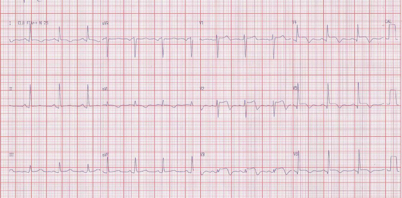 Síndrome de Tako Tsubo en mujer hipotiroidea con enfermedad arterial oclusiva de MI