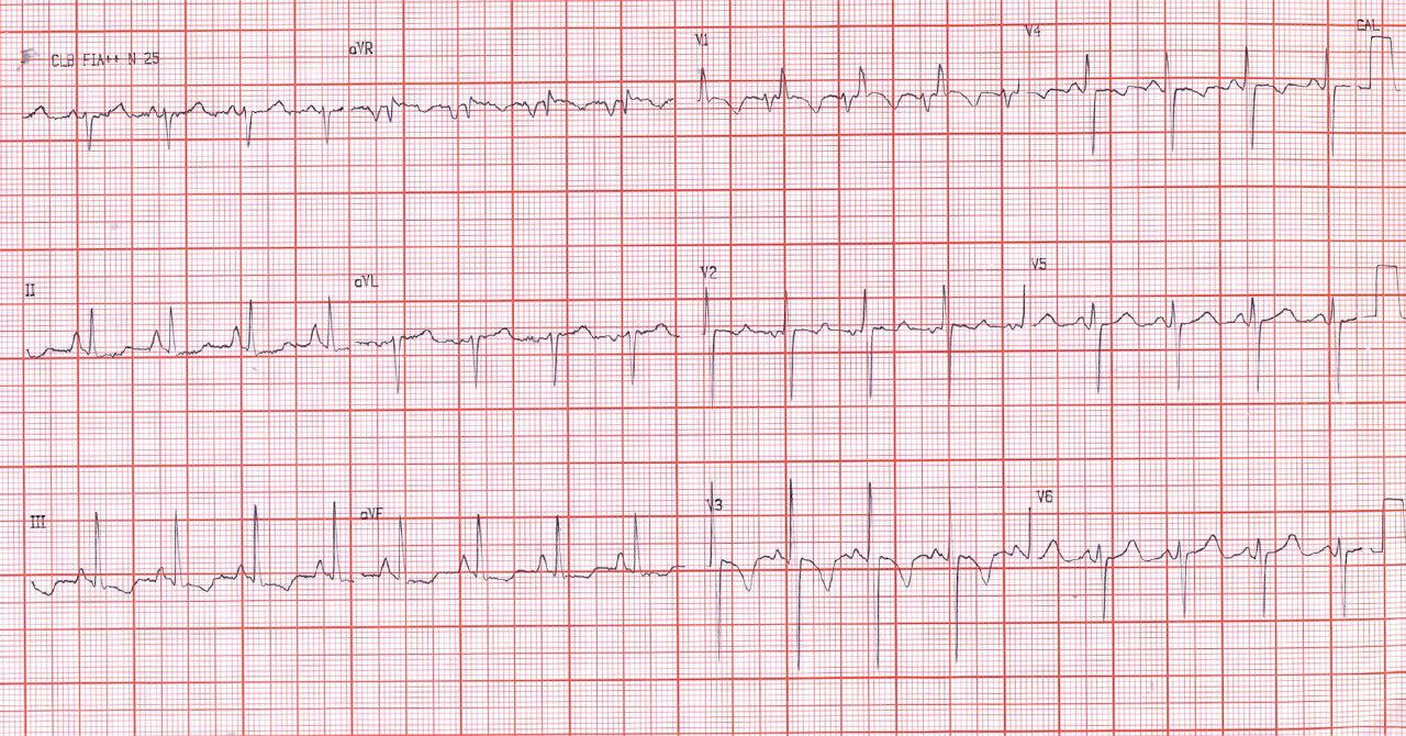 Mujer de 27 años con disnea de reposo por estenosis mitral severa e hipertensión pulmonar