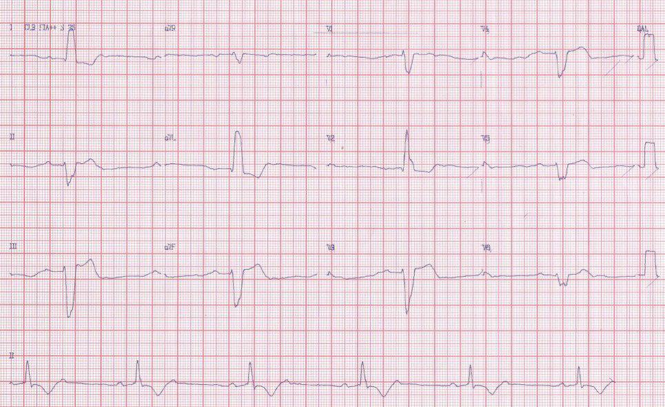 Mujer de 47 años con distrofia miotónica y antecedentes de episodios sincopales