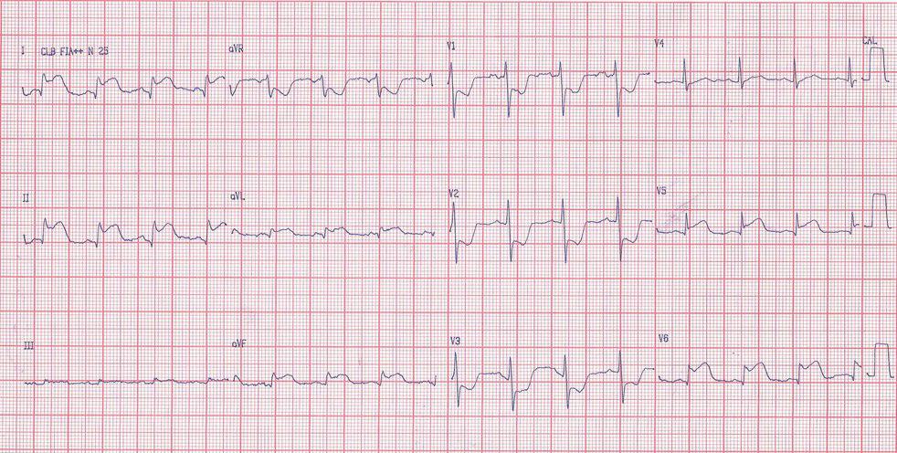 Paciente de 82 años con angor y mareos por lesión de arteria marginal de Cx, su angioplastia y RIVA por reperfusión