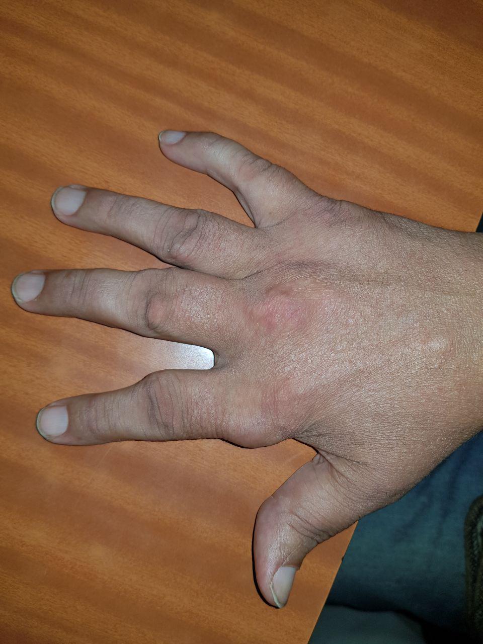 Tofos gotosos en paciente hipertenso medicado con tiazidas