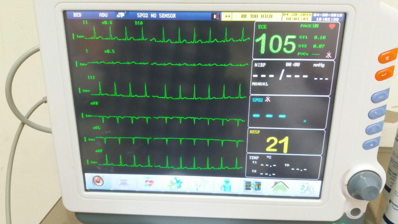 Paciente femenina de 27 años con palpitaciones por Enfermedad de Graves Basedow