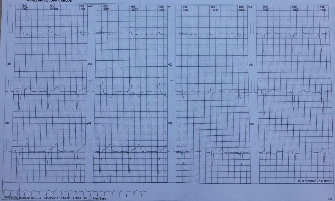 Mujer de 85 años con miocardiopatía chagásica crónica portadora  de MP VVI