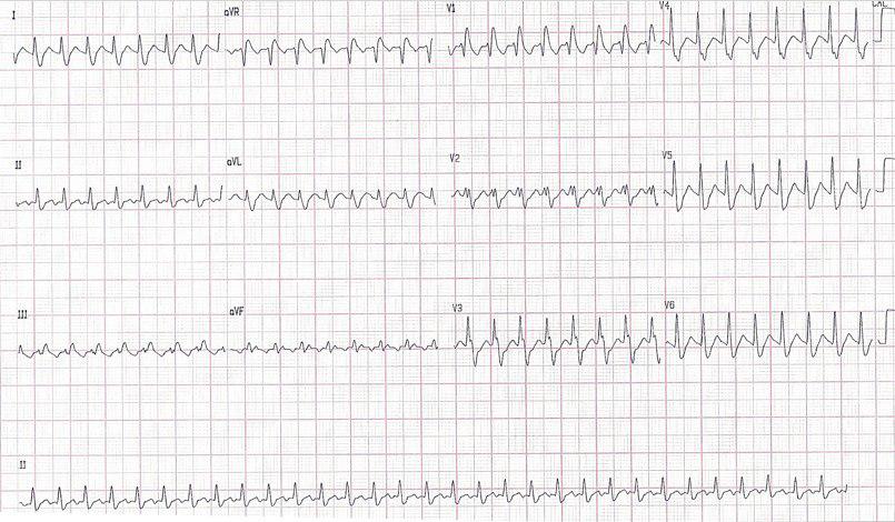 Joven de 27 años con taquicardia por reentrada ortodrómica y BCRD previo