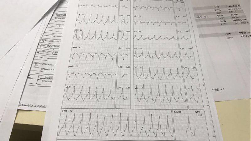 Taquicardia catecolaminérgica originada en TSVD durante test ergométrico