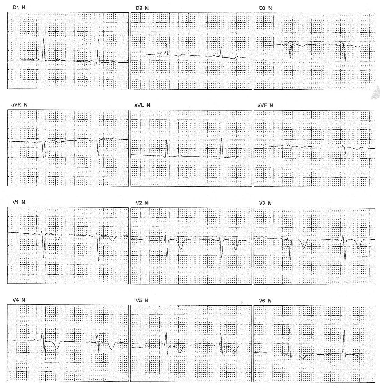 Mujer de 66 años con BCRI intermitente y ondas T electrotónicas por fenómeno de Memoria Cardíaca