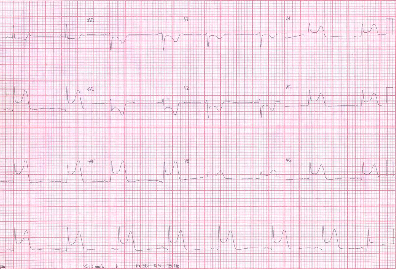 Angina de Prinzmetal en mujer de 66 años con episodio de angor prolongado y  troponina normal