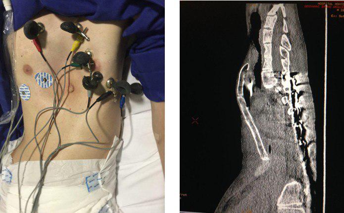 Paciente de 17 años con síndrome de Marfan, pectum excavatum y fenocopia de Brugada