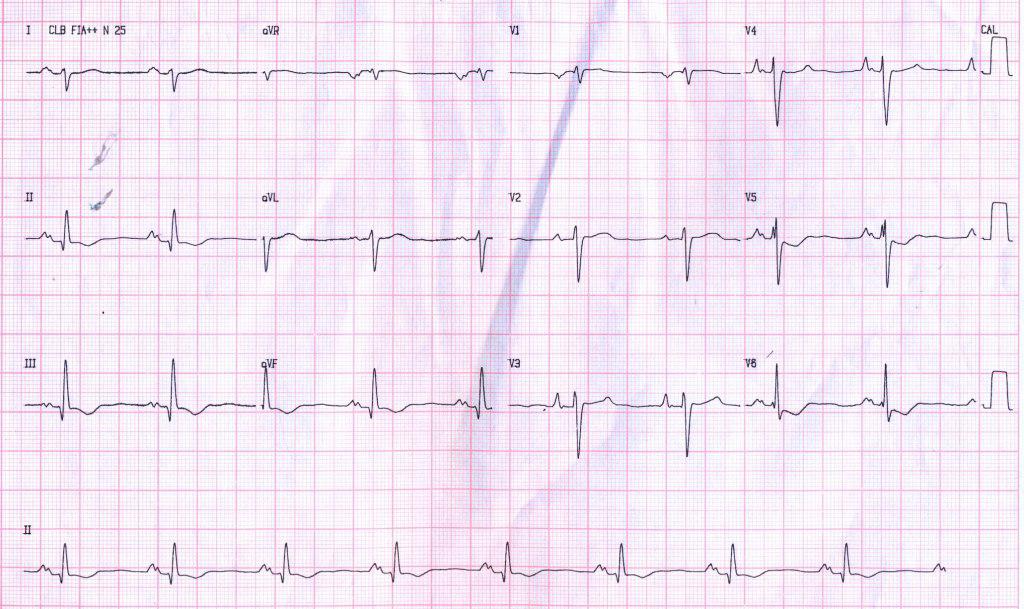 Paciente de 37 años con angor, disnea y síncope originados en miocardiopatía restrictiva por amiloidosis