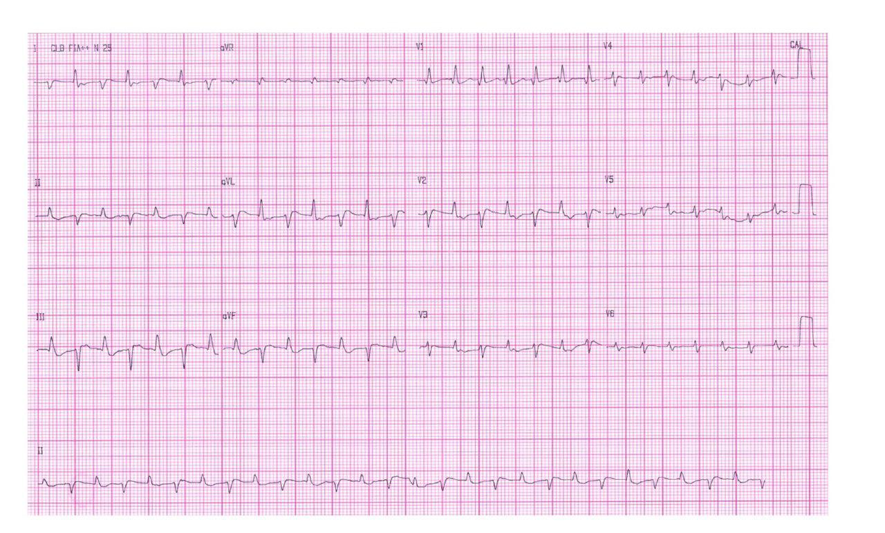 Mujer de 75 años, HTA con FA crónica que presenta taquicardia ventricular bidireccional por intoxicación digitálica