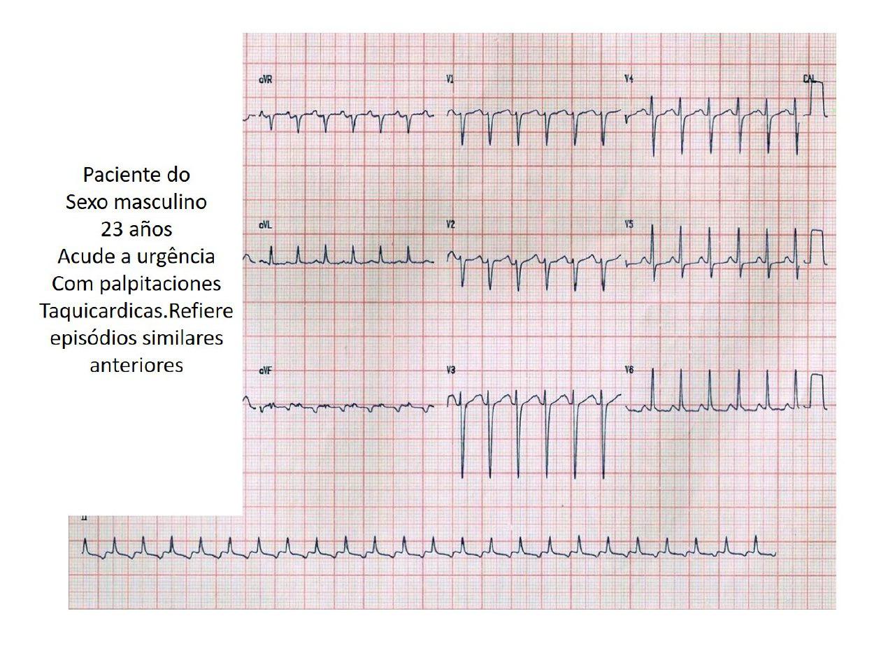 Paciente de 23 años con taquicardia incesante de Coumel