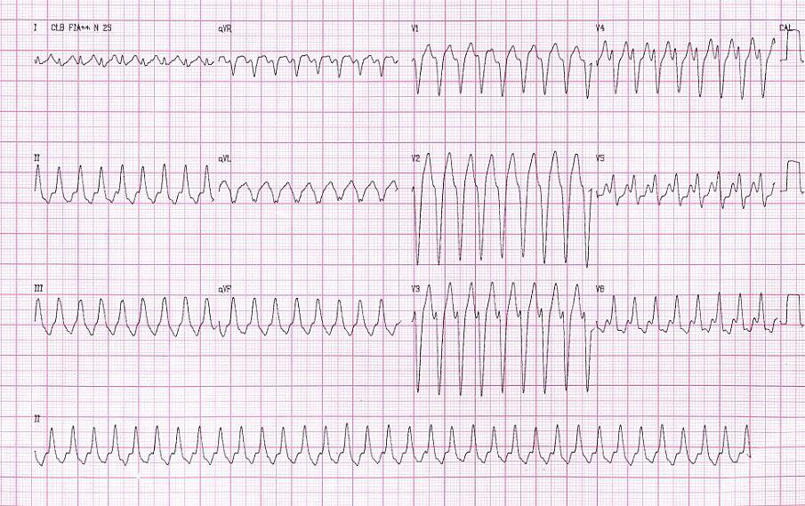 Taquicardia ventricular monomorfa del TSVD en paciente de 39 años