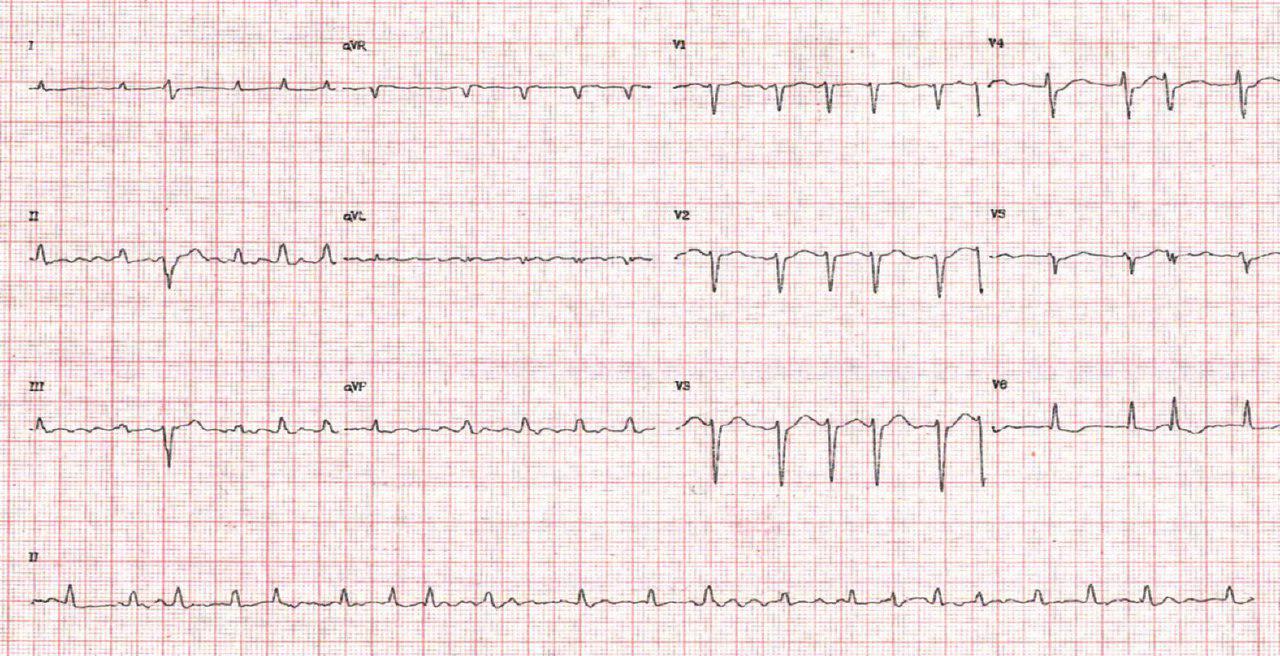 Taquicardia fascicular posterior por intoxicación digitálica en mujer de 79 años tratada con digoxina por FA crónica