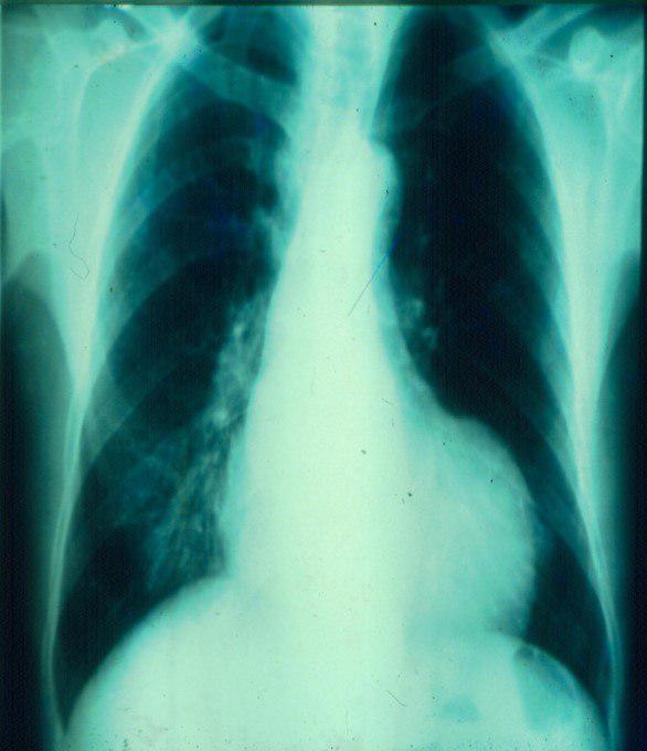 Masculino con angor y disnea y antecedente de infarto antiguo presenta aneurisma de cara anterior de VI