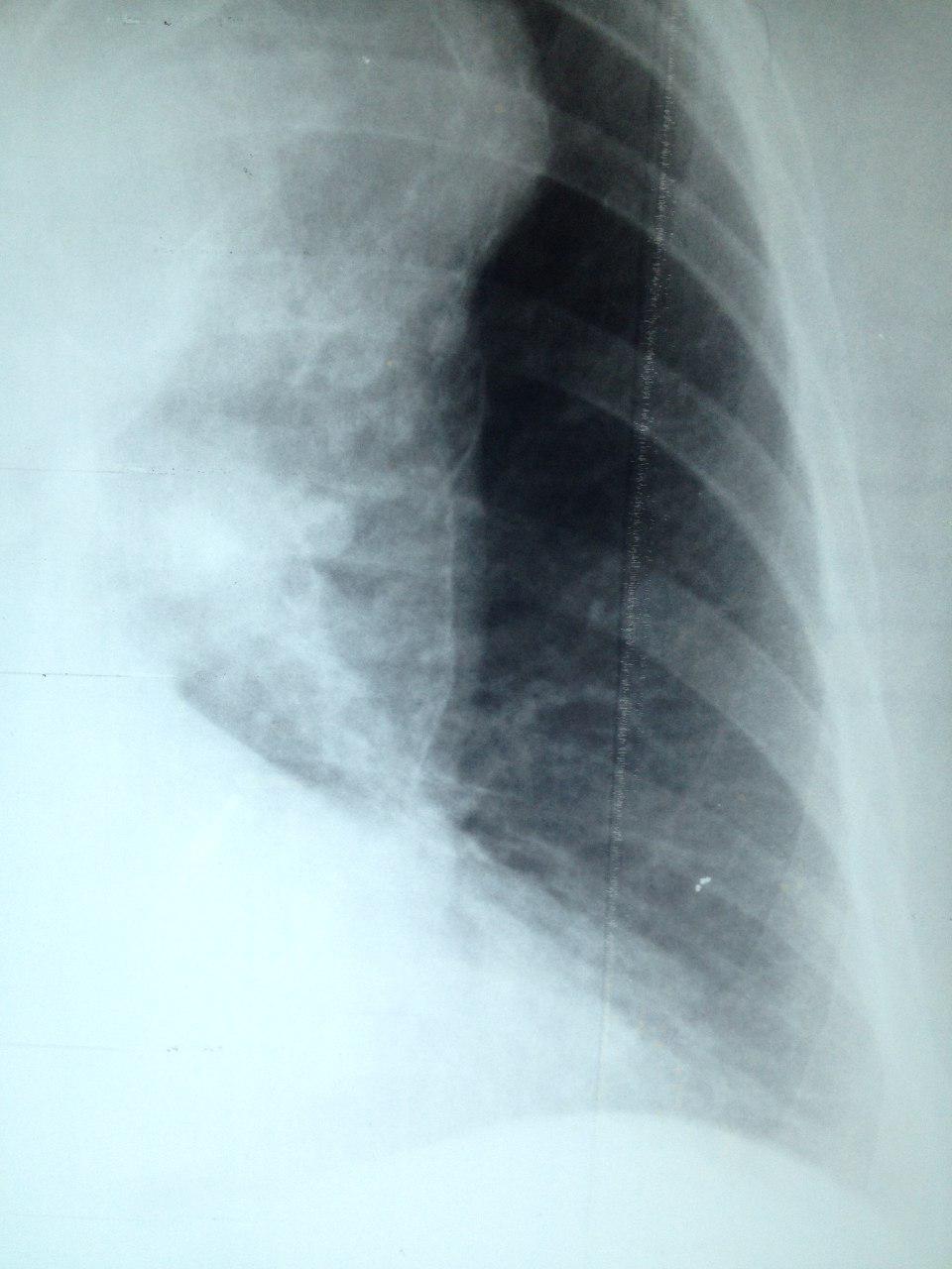 Paciente de 72 años hipertenso con dolor toráccico intenso irradiado a dorso