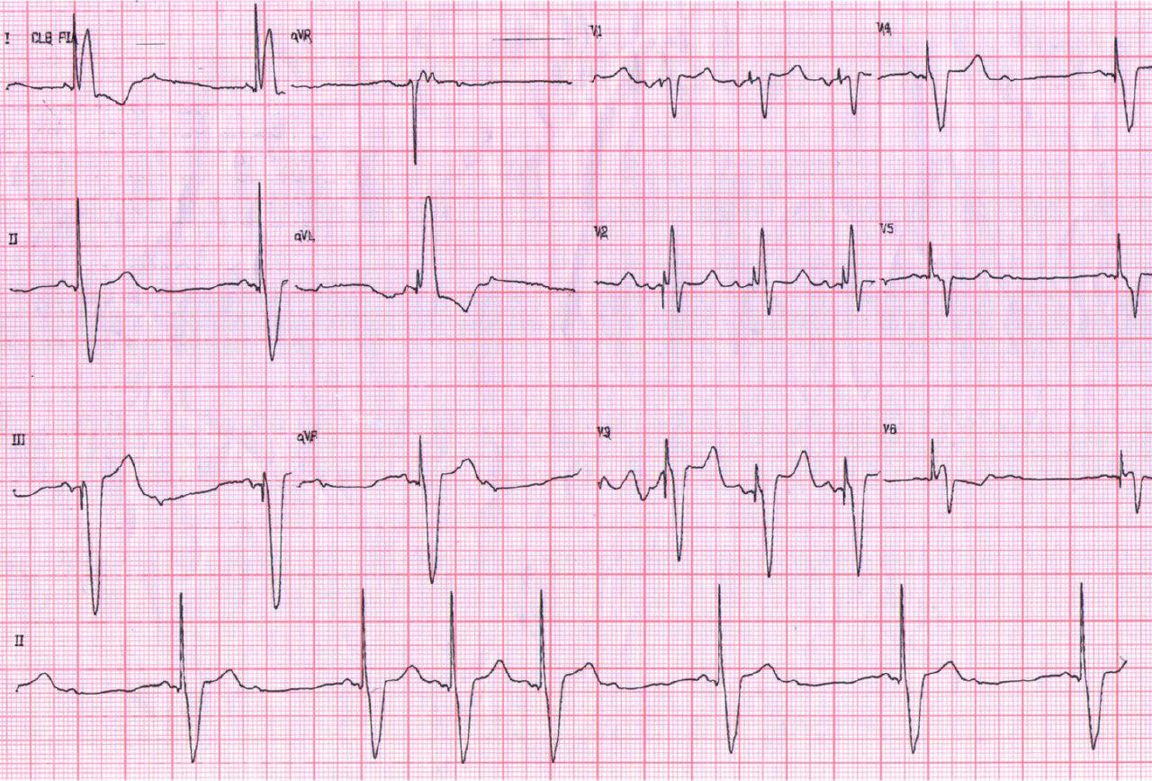 Episodio sincopal tras un año de implante de MP por alta impedancia de electrodo ventricular y fractura
