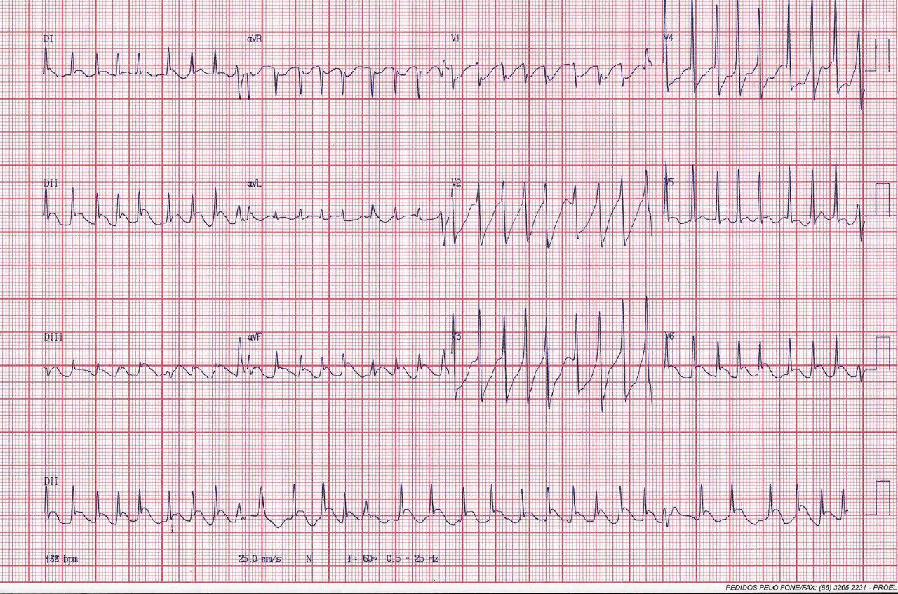 Paciente de 56 años con ondas J gigantes por hematoma intracerebral