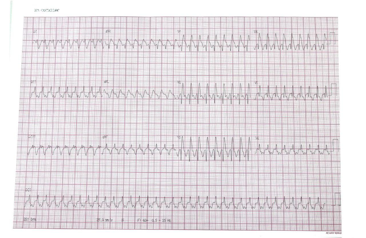 Taquicardia SV por vía accesoria en niño de 12 años con anomalía de Ebstein