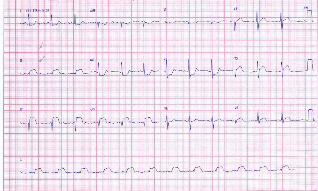 Síndrome coronario agudo por oclusión de CD y posterior angioplastia exitosa