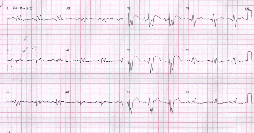 Paciente portador de miocardiopatía hipertrófica que evoluciona a miocardiopatía dilatada