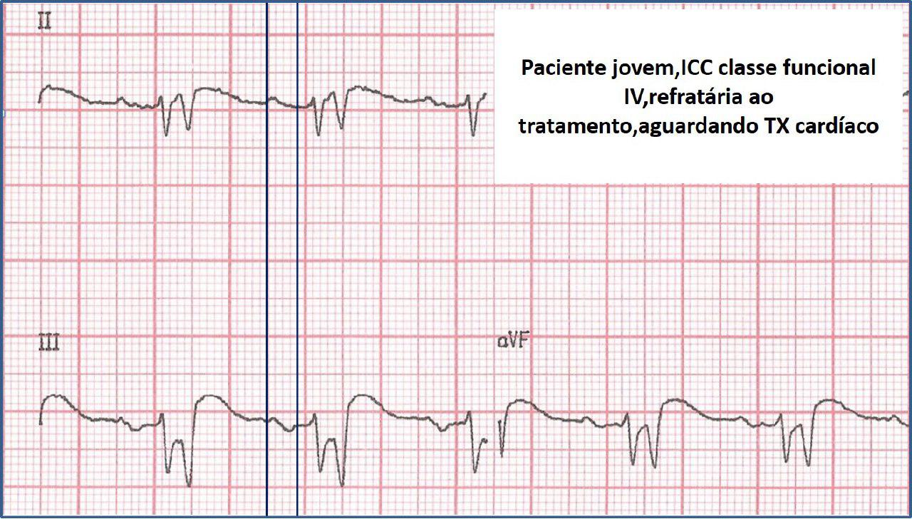 Joven portador de miocardiopatía no compactada en lista de espera de transplante cardíaco
