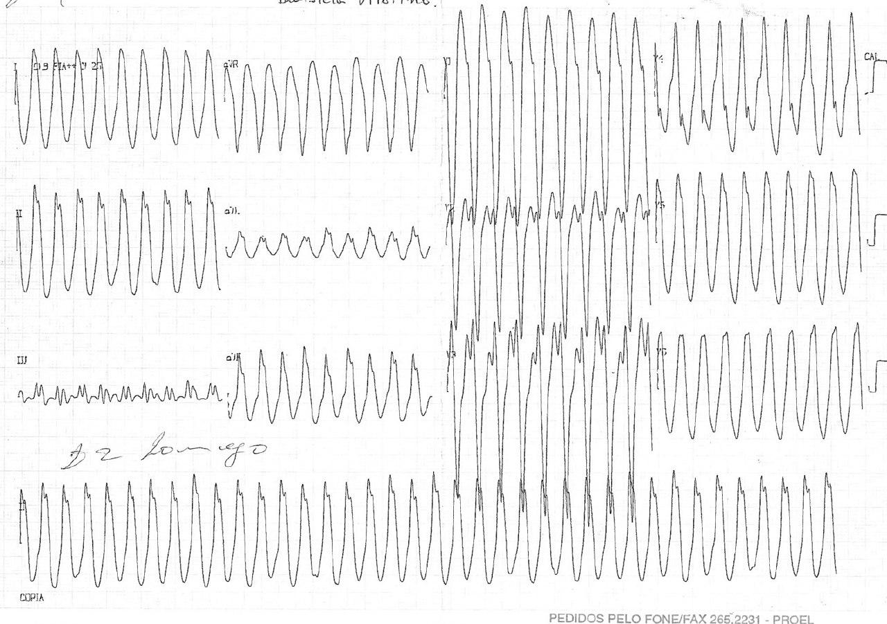 Joven de 17 años presenta síncope por conmotio cordis por golpe de karate