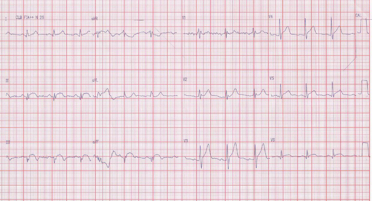 Joven de 31 años con angor post consumo de cocaina debido a trombo en CD que se aspira