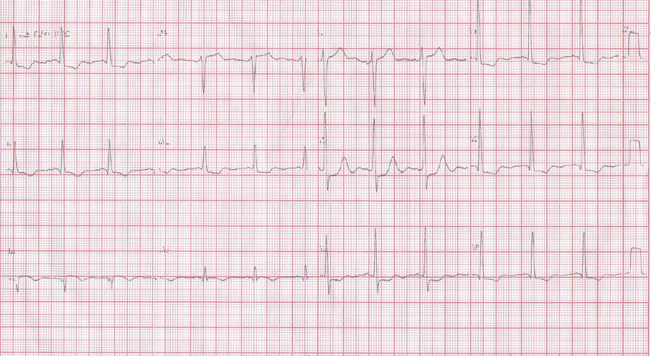 Paciente de 67 años con infarto previo y angina progresiva por suboclusión de TCI